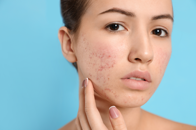 چه مواد غذایی باعث جوش صورت می‌شوند؟