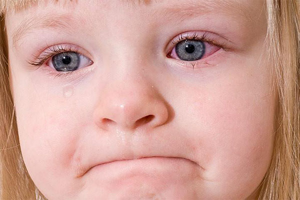 قرمزی یا اشک‌ریزش چشم‌ها