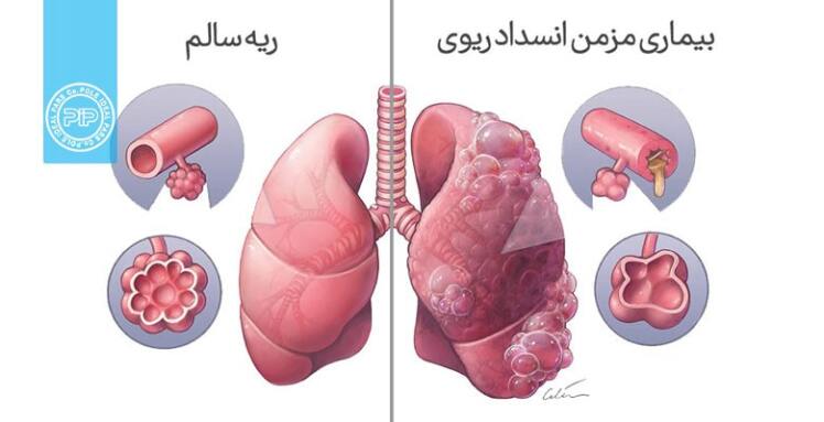 تحولی در تشخیص بیماری انسدادی مزمن ریه 
