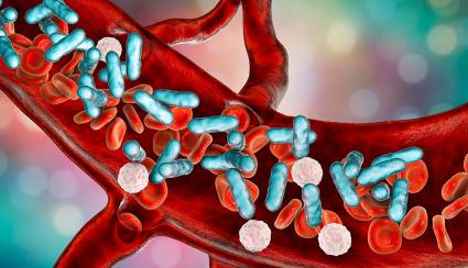 sepsis