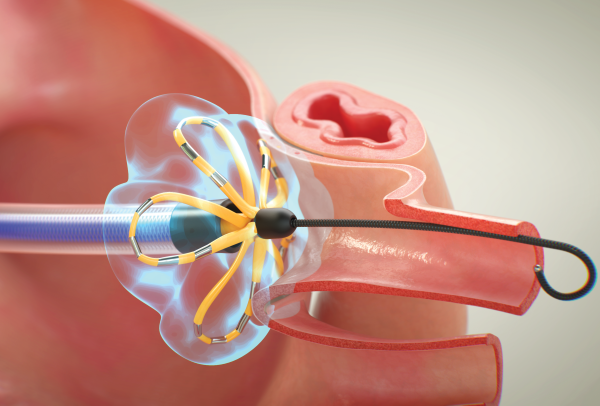 ابلیشن قلبی (Ablation)